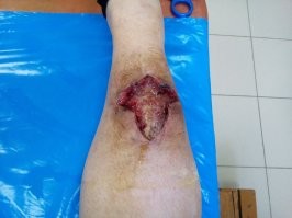 Мне сначала сказали, что это обычный ушиб...