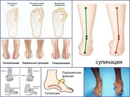 "Вальгусов" несколько видов. Пятки, стопы, пальца..... Это искривление в общем-то. Нужно рентген.
Пятка наружу, относительно вертикали, тоже вальгус...