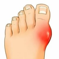 артрит, не звиздите