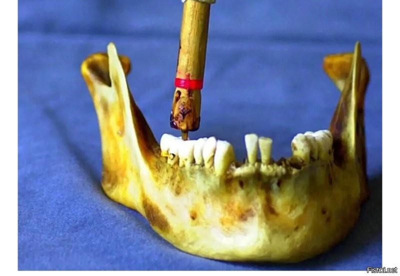Интересно, а как таким сверлом просверлить зуб, если в наличии есть и верхняя челюсть? 
Хрен так рот откроешь.