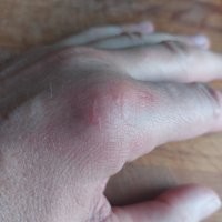 Друже, аналогично. В цеху газокомпрессорной станции. Работает 4 ГПА. Это турбина самолёта примерно. В стройотряде, на консервном заводе, в цеху. Прислонился к батарее, по которой шло паровое отопление. Шрамы так и остались (фото). В армии само собой.  В карауле садишься зимой, спиной к вентиляции склада, наматываешь ремень автомата на руку, чтоб не вытащили втихаря. Воздух дует тёплый от холодильника. Лафа. В каптёрке. Одну шинель под себя, вторую сверху. На природе вообще несчётное количество раз. В шкафу тоже приходилось. И Действительно душно