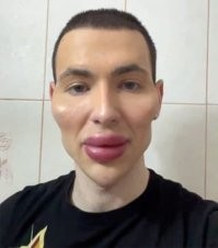 Странная штука жизнь. 
 Одни от этого болеют, другие наоборот себя так уродуют.