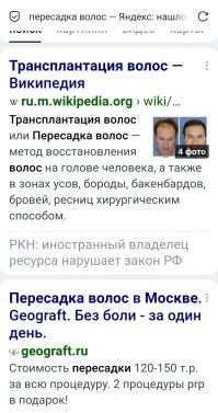 Можно. Пересаживают. Но дорого это. 
Проще налысо побриться. :)