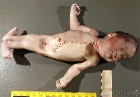 Походу это: сиреномиелия   аномалия развития в виде сращения нижних конечностей. Они срастаются таким образом, что становятся похожи на хвост рыбы, а сам ребёнок на русалку или сирену (отсюда название).