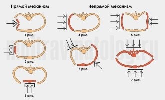 переломы разные бывают. Одни болезненные, другие не очень.