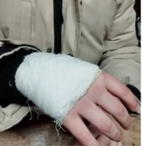 Гипс забыли наложить...