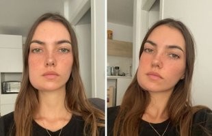 Это нормально после удаления нижнего непрорезавшегося зуба мудрости. На 3-4 день бывает.