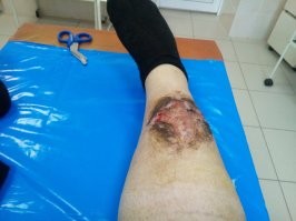 Кстати, да. Вспомнил свой случай, примерно, 6-и летней давности. Абсолютно трезвый подходил я к маршрутке в виде пазика, дело было в феврале. Я наступил ногой на бордюр и уже закидывал другую ногу на ступеньку выше, как поскользнулся и улетел под днище автобуса. Не полностью, конечно, тем более, я крупный. Люди добрые, что стояли на остановке и в салоне, подскочили и вытащили меня из-под автобуса. Помню, в самом начале была безумная просто боль, но, на удивление, быстро отпустило. Домой приехал - болит сильно, брюки снимаю - шишка с крупный мужской кулак на месте удара об ступеньку. Картинка, хоть я и не из слабохарактерных, впечатляющая. Так вот, боль нарастала, поэтому я, выпив, для храбрости, чес.слово, вызвал скорую, которая по итогу ехать не хотела и сын меня отвёз на такси (кстати, на въезде в больничный двор, нас, в такси, не хотела пропускать авто   л е д и   тварь и таксист ещё отвоёвывал наше право, как можно скорее, попасть в травмпункт) в больницу. Так вот, когда я залазил на стол рентгенографической установки, шишка уже полностью опала. Снимок показал отсутствие трещин и врач отправил меня домой лечиться мазью. Но через неделю рана на месте ушиба загноилась и в итоге доктор, который меня принимал вечером в приёмном покое, сказал, что я мог и без ноги остаться. Сделали операцию и я валялся две недели в больнице, а потом около 3-х месяцев дома на больничном. Чтобы понятно было, прикреплю фото. Прошу простить меня за "много букав" и фото для крепких желудком, как говорится. Первое фото от 7-го марта - это день падения и ушиба, а ровно через месяц - это открытая рана после операции (очень долго заживала).