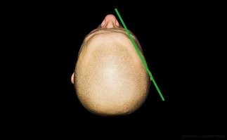 На фото две царапины. Верхняя идёт от губы. Если бы это была пуля, она бы снесла пол скулы, по пути к уху. Если только стрелял не Уэсли Гибсон.