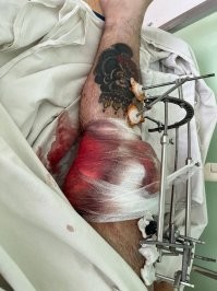 Попытаюсь чуть уравновесить хорошей новостью)

В Воронеже армянину на стрелке прострелили коленную чашечку.

Как пишет подписчик, ара наехал на местного жителя из-за парковки, тот его несколько помял. Ара такого позора снести не смог и позвал турборусича на стрелку «адын на адын». Наш мужик молодцом оказался, не поверил аре и прихватил с собой пару друзей - чай не на турнир рыцарский позвали. Придя на стрелку ,мужик увидел там армянина с группой поддержки. Одного выстрела в воздух оказалось достаточно, чтобы спугнуть стаю армяшек, бросивших своего вожака на «поле боя». Второй выстрел пришёлся уже по самому аре - прямо в коленную чашечку, превратив её в костяной фарш. Напоследок местные его ещё и отх*ячили для профилактики, сейчас он лежит в больничке, лечится и рефлексирует, пытаясь понять, что же он сделал не так.
