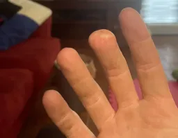 А мне повезло не отарвало мочку пальца снесло, мясо наросло больше чем надо, ну и ладно зато целый