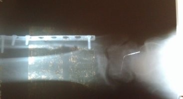 Часть на машине, часть пешком, с тростью, которую сосед подогнал, увидев, как я по лестнице спускался. 
Лифта у нас не было, пятиэтажка. 

Сначала в травму на машине, причем их вход был закрыт, пришлось обходить здание и через другой вход заходить. 
Там, врач на второй этаж послал, рентген на втором этаже. 
Потом уже в больницу, тоже на машине.