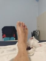 Мне как то гантеля на ногу упала, теперь в суставе штырь