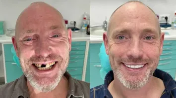 Некорректное сравнение.
На первом фото лицо освещено снизу - излюбленный приём кинооператоров, чтобы придать отрицательному персонажу зловещий вид. Плюс прищуренные глаза - и получите злодея.
А поставить нормальный свет - и получится весёлый добродушный чувак без зуба.