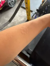 Ну тут похоже на лишай. У самого такое было