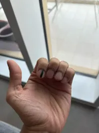 Подногтевая меланома, Меланома ногтя   это тип рака кожи, который развивается под поверхностью ногтевой пластины. Называется злокачественное заболевание подногтевой меланомой и выглядит как коричневая или черная полоса.
Так что для парня у меня плохие новости