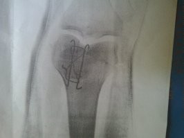 Как то в глухих лесах Карелии случилась у меня проблема с кишечником. Так за те секунды что она решалась мне жопу и мошонку обгрызли так что сидеть не мог и лежал только на животе. Укус мошки в "нежные" места все чувствуют практически сразу. И главное это была рыбалка с женой где готовила она и водку пить было нельзя. Но после покушения насекомых на меня бухать стало можно и все прошло!!! А следующая "трезвая" рыбалка закончилась переломом надколенника моего, до сих пор с металлом.