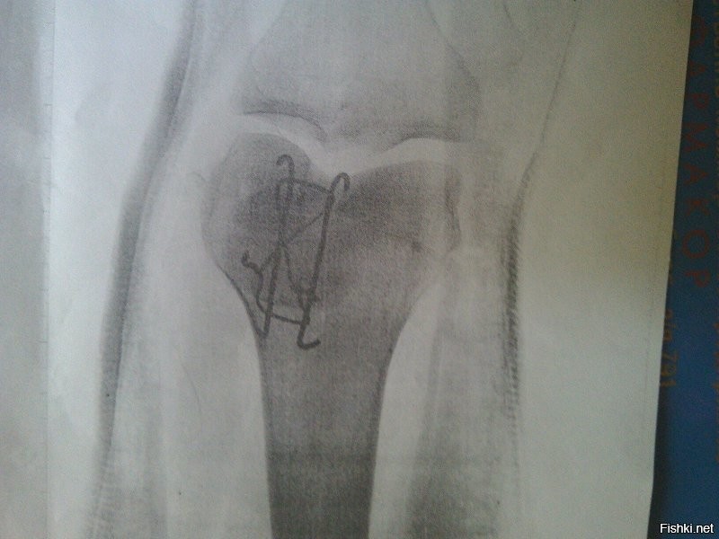Как то в глухих лесах Карелии случилась у меня проблема с кишечником. Так за те секунды что она решалась мне жопу и мошонку обгрызли так что сидеть не мог и лежал только на животе. Укус мошки в "нежные" места все чувствуют практически сразу. И главное это была рыбалка с женой где готовила она и водку пить было нельзя. Но после покушения насекомых на меня бухать стало можно и все прошло!!! А следующая "трезвая" рыбалка закончилась переломом надколенника моего, до сих пор с металлом.