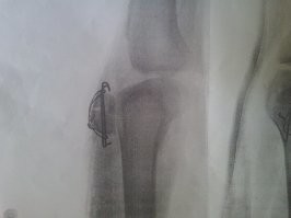 С такой миханизмой годик походишь, потом без нее только лежать сможешь. После перелома несколько лет восстанавливался, тяжкое это дело.