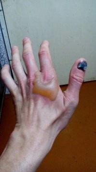 Жарил сало.
В тот момент , когда поднял большую чугунную сковородку с кипящим жиром с плиты , у сковородки отломалась ручка.
Очень больно.