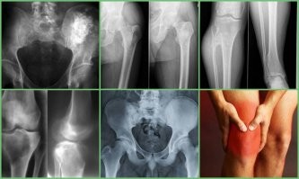 Дим я со вторника в синей яме...
Диагноз пинзес, просто доживаю... рак костей и не излечим. Потратил туеву хучу денег, всё напрасно...