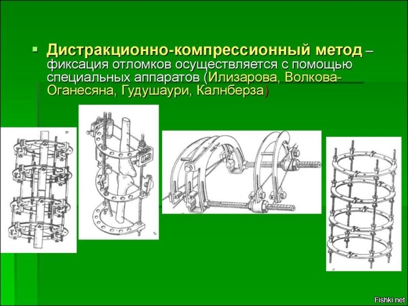 Вот они основные разновидности! А какой на какой перелом ставят, наверное действительно только хирург ответить сможет! Мой, Волкова-Оганесяна стоял жестко на плечевой кости, выставленной после перелома со смещением кости и осколков, с тонкими спицами, как велосипедными, проходящие через ткани и кость насквозь! 8 штук, 8 сквозных отверстий! В ЦИТО я видел аппарат с шарнирами, который крепиться ближе к суставам! На ногах и на бедре, и на голенях! На "дробленках"! Как какой называется, не знаю конечно!