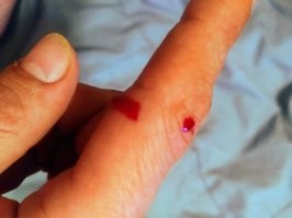 Вот так кусается домашняя белка дегу. Палец насквозь. Руку раздуло, боль не утихала, пришлось в травму ехать в 3 ночи. Видели бы вы глаза врача, когда я сказал, что меня белка укусила... "Ты где, блин, белку в три ночи нашёл???" Последствия ощущались аж полгода. 
Причём обычно она вполне ручная, но после попытки ссадить двух белок, пришлось через пару часов их разнимать. Одна запрыгнула ко мне на руки, посидела полминуты, а потом со всей дури тяпнула. Но больше такого не случалось, кстати. 
Сейчас сидит на мне, просит ей подбородок почесать. Люблю эту скотинку.