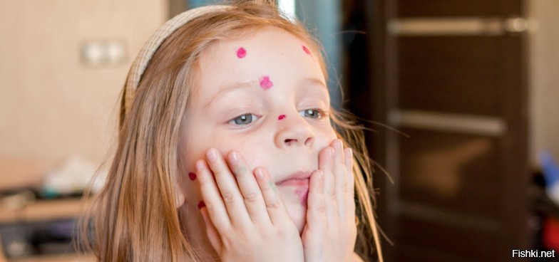 А, нас с сестрой при ветрянке кастелянкой почему-то мазали (раствор «Фукорцин»), мы в розовых пятнышках ходили.