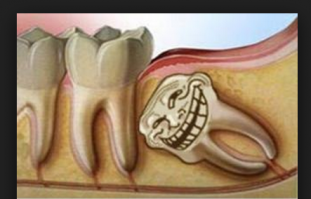 Зуб мудрости - тролль ещё тот