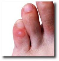 поясняю, какие мозоли в сандалиях и на каком месте..