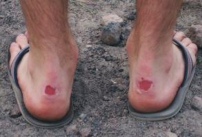 поясняю, какие мозоли в сандалиях и на каком месте..