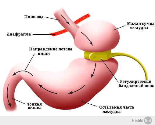 Бандаж желудка,100 тыс р и никаких проблем через три месяца.