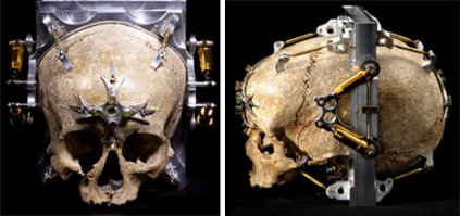 Камера из черепа 12 ти летней девочки умершей 150 лет назад. Камера с кровью больного СПИДом, последняя используется только для фото  людей болтных СПИДом.