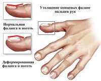 - целиакия (или глютеновая энтеропатия - мультифакториальное заболевание, нарушение пищеварения, вызванное повреждением ворсинок тонкой кишки некоторыми пищевыми продуктами, содержащими белки - глютен и близкие к нему белки злаков);
- цирроз печени и другие заболевания печени;
- дизентерия;
- болезнь Грейвса (диффузный токсический зоб, базедова болезнь - угрожающее жизни заболевание щитовидной железы);
- гиперактивность щитовидной железы;
- другие виды рака, в том числе печени и ЖКТ, лимфома Ходжкина.