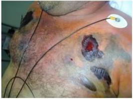 ее укус не так сильно болен.. порой даже можно и не почувствовать сам укус, но последствия конечно серьезны...