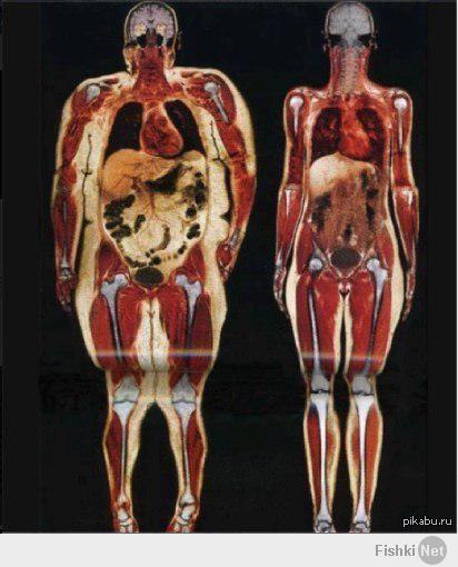 Наверное в узелок завязывают )) Кости у тучных такие же, как и у обычных людей.
"Снимок просканированного тела 115-килограммовой и 55-килограммовой девушки. Белый слой жира буквально повсюду, даже на органах!"