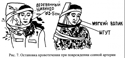 На шею тоже можно жгут наложить. Глупо считать что это невозможно.