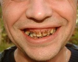 Уж лучше просто здоровые зубы,а то может быть и так,после таких манипуляций