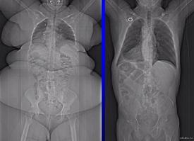 Рентгеновский снимок тела 400-килограммового мужчины 