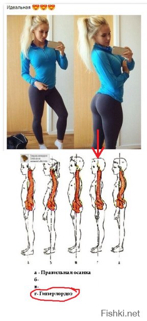 Гиперлордоз, лордотическая осанка, лордическая осанка - деформация позвоночника в поясничном отделе с выпуклостью кпереди