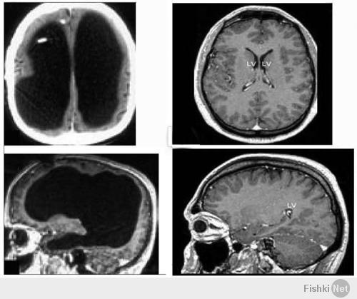 На картинке - аналогичный случай. 
Справа - обычный мозг, слева - мозг одного француза, в том виде, как это обнаружили врачи. Мужику было уже 44 года, женат двое детей. Его IQ оценили в 75, что лучше, чем у многих посетителей Фишек...