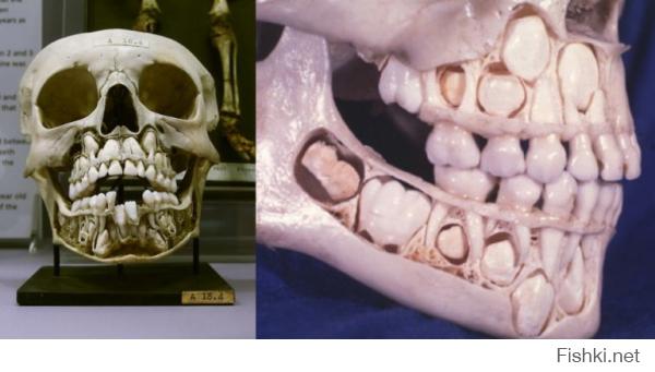 Фигня. Вот череп ребенка с молочными зубами. Лучше-бы не видел.
