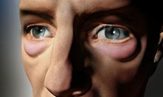 а мешки подглазами