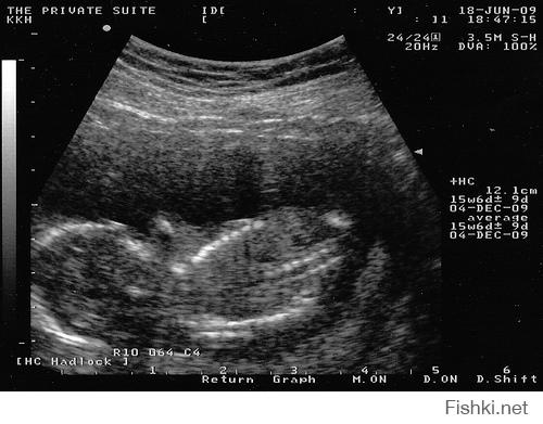 Узи на 39 неделе. 15 Недель беременности по УЗИ. Видео УЗИ 15 неделя беременности. Размер плода 15 недель беременности пол.