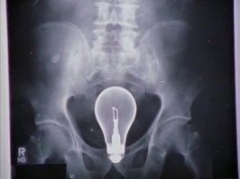 Китаец с ножом в голове сам пришел к врачу