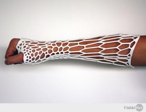 Современный экзоскелетный гипс, созданный при помощи технологии 3D-печати