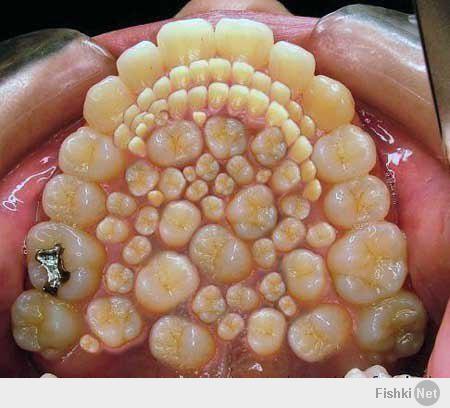 Полиодонтия — аномалия развития: избыточное количество зубов.