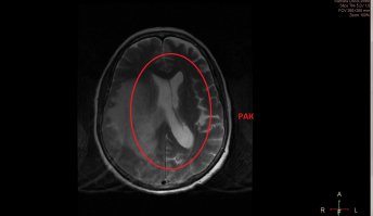 Вот фото (слабонервным не смотреть, но такова жизнь что это может случится с каждым, если почувствовали немение пальцев, быыыстро на МРТ!!! Кто знает что дальше будет! Если конечно вам дорога ваша жизнь):