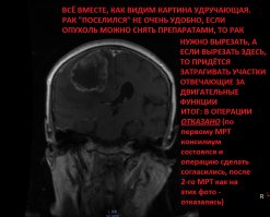 Вот фото (слабонервным не смотреть, но такова жизнь что это может случится с каждым, если почувствовали немение пальцев, быыыстро на МРТ!!! Кто знает что дальше будет! Если конечно вам дорога ваша жизнь):