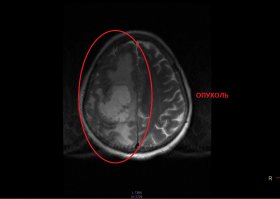 Вот фото (слабонервным не смотреть, но такова жизнь что это может случится с каждым, если почувствовали немение пальцев, быыыстро на МРТ!!! Кто знает что дальше будет! Если конечно вам дорога ваша жизнь):
